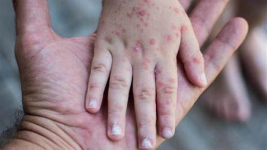 caz neasteptat un copil a murit la cativa ani dupa ce s a vindecat de rujeola afectiunea sspe care i a adus sfarsitul 68cbb26842a24