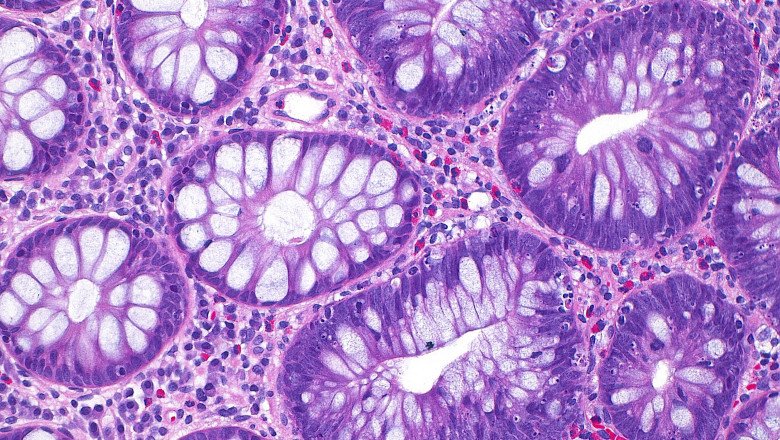 cum a ajuns cancerul de colon sa afecteze tot mai multi tineri si care este cauza principala indicata de studii 68e61cee6d9c8